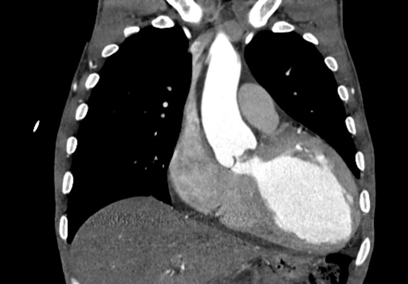 File:Coarctation of aorta with aortic valve stenosis (Radiopaedia 70463-80574 C 74).jpg