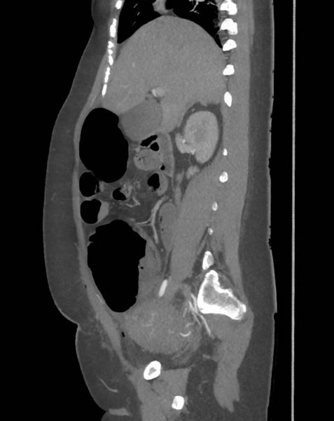 File:Colonic pseudo-obstruction (Radiopaedia 79752-92980 C 31).png