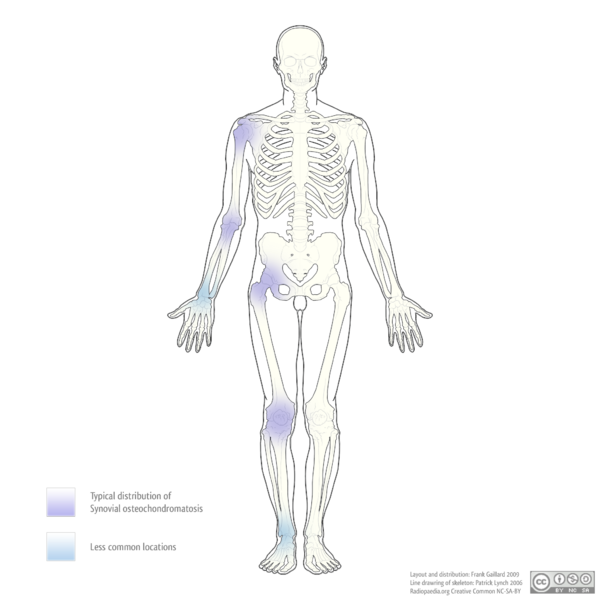 File:Distribution of synovial osteochondromatosis (diagram) (Radiopaedia 7626).png