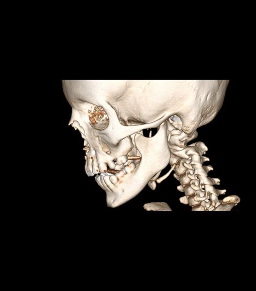 File:Nasoorbitoethmoid fracture (Radiopaedia 90044-107205 3D VRT 32).jpg