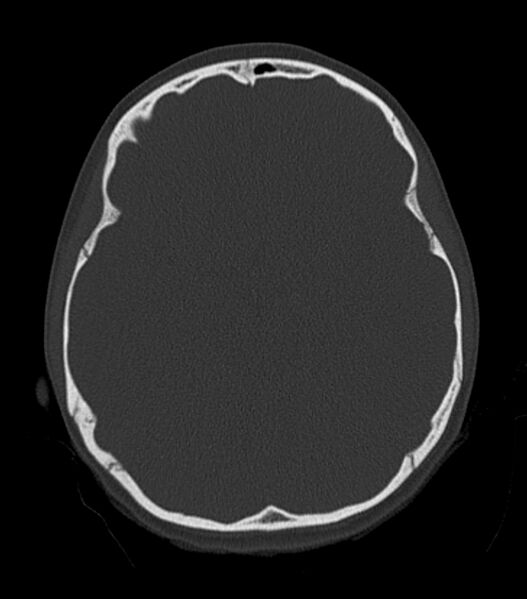 File:Nasoorbitoethmoid fracture (Radiopaedia 90044-107205 Axial bone window 97).jpg