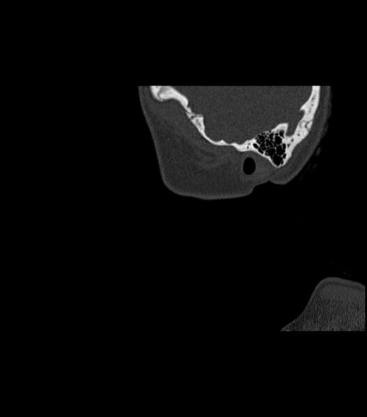File:Nasoorbitoethmoid fracture (Radiopaedia 90044-107205 Sagittal bone window 15).jpg
