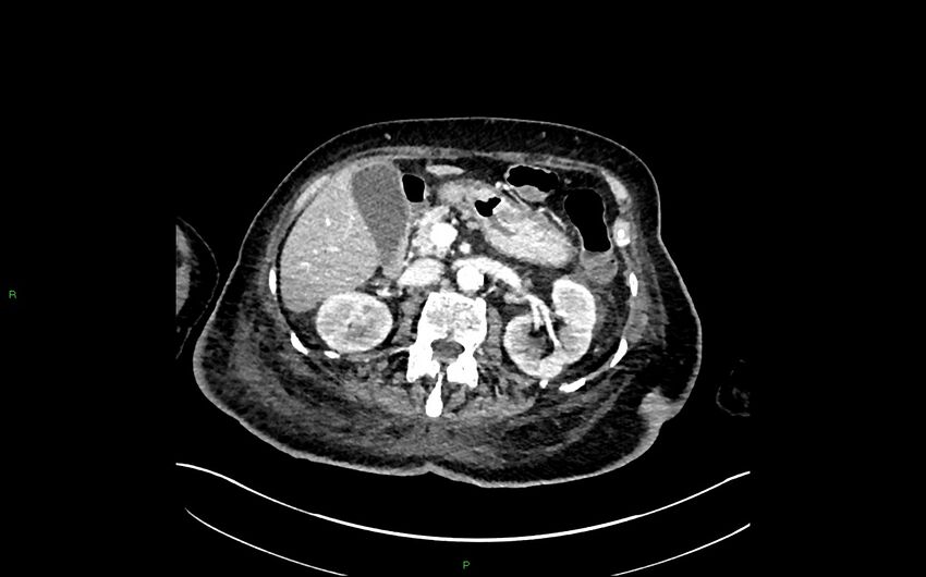 Neo-terminal ileal stricture (Crohn disease) (Radiopaedia 33790-34948 A 151).jpg