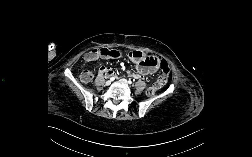 Neo-terminal ileal stricture (Crohn disease) (Radiopaedia 33790-34948 A 307).jpg