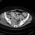 Nerve sheath tumor - malignant - sacrum (Radiopaedia 5219-6987 A 8).jpg