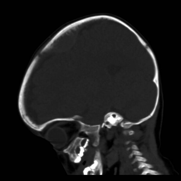 File:Neuroblastoma with skull metastases (Radiopaedia 30326-30958 Sagittal bone window 14).jpg