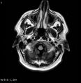 Neurosarcoidosis (Radiopaedia 10930-17204 Axial FLAIR 1).jpg