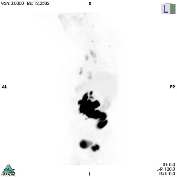 File:Non-Hodgkin lymphoma involving seminal vesicles with development of interstitial pneumonitis during Rituximab therapy (Radiopaedia 32703-33675 PET cor 3D MIP 5).jpg