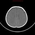 Non-accidental injury - bilateral subdural with acute blood (Radiopaedia 10236-10765 Axial non-contrast 15).jpg