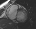 Non-compaction of the left ventricle (Radiopaedia 69436-79314 Short axis cine 180).jpg