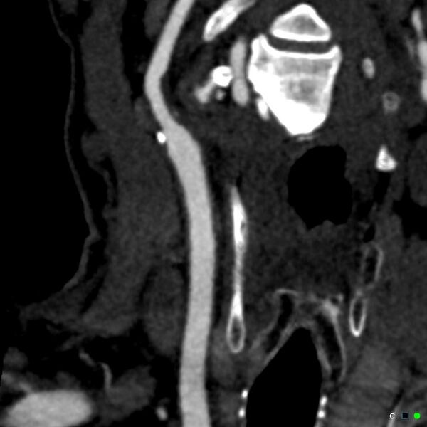 File:Non-occlusive intraluminal internal carotid artery thrombus (Radiopaedia 37751-39658 C 34).jpg