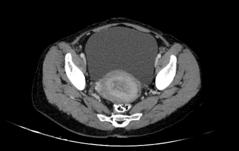 File:Non-puerperal uterine inversion (Radiopaedia 78343-91094 A 26).jpg