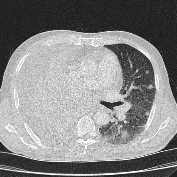 File:Non small-cell lung cancer (Radiopaedia 24467-24769 lung window 23).jpg