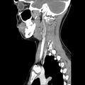 Normal CT of the neck (Radiopaedia 14575-14500 Sagittal C+ 36).jpg