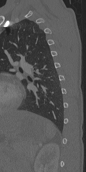 File:Normal CT thoracic spine (Radiopaedia 40181-42688 Sagittal bone window 3).png