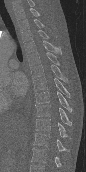 File:Normal CT thoracic spine (Radiopaedia 40181-42688 Sagittal bone window 33).png