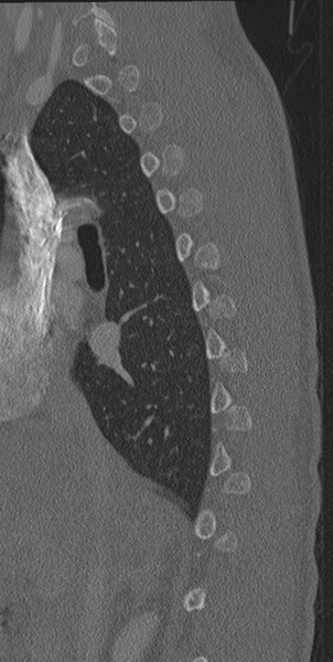 File:Normal CT thoracic spine (Radiopaedia 40181-42688 Sagittal bone window 51).png