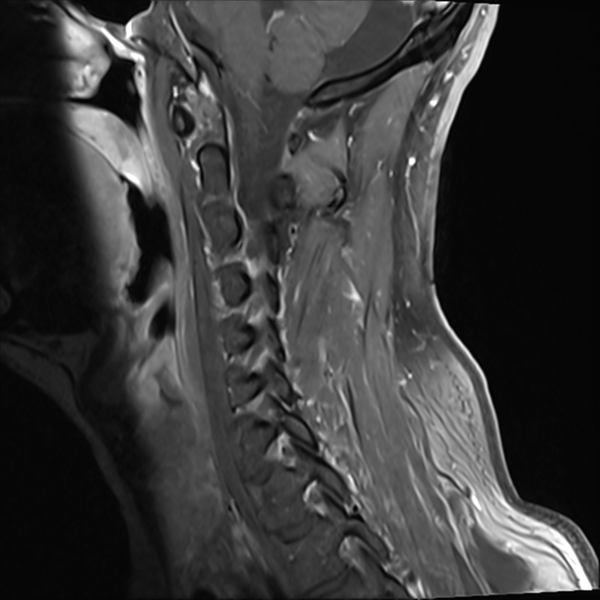 File:Normal MRI cervical spine (infection protocol) (Radiopaedia 53916-60039 I 10).png