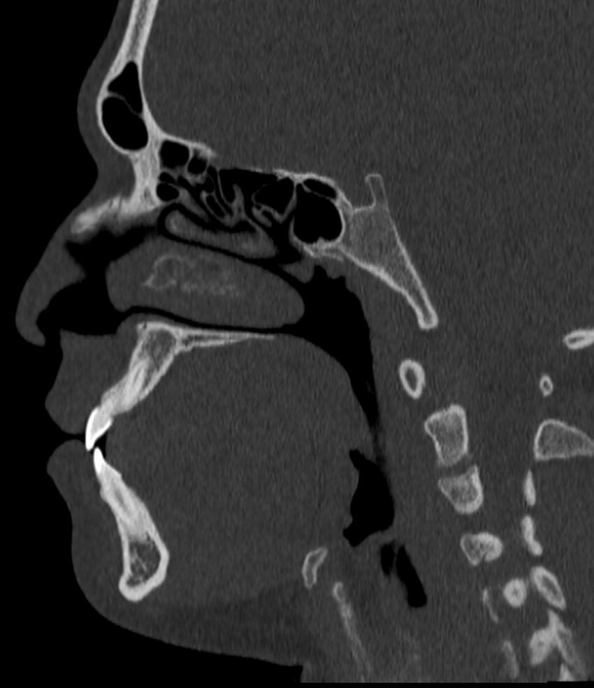 Normal facial bone CT (Radiopaedia 88742-105476 Sagittal bone window 81).jpg