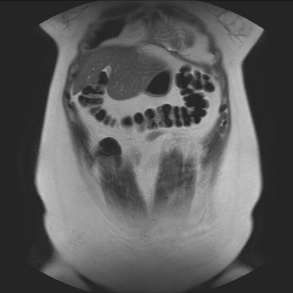 File:Normal liver MRI with Gadolinium (Radiopaedia 58913-66163 Coronal T2 10).jpg