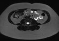 Normal liver MRI with Gadolinium (Radiopaedia 58913-66163 E 1).jpg