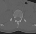 Normal lumbar spine CT (Radiopaedia 46533-50986 Axial bone window 2).png