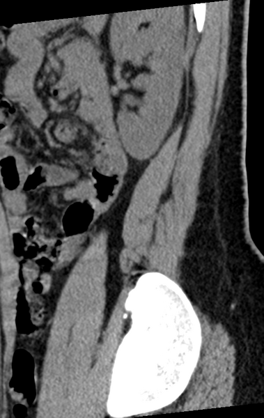 File:Normal lumbar spine CT (Radiopaedia 46533-50986 C 9).png