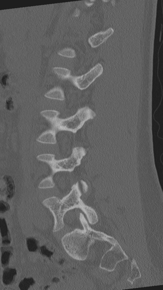 File:Normal lumbar spine CT (Radiopaedia 46533-50986 Sagittal bone window 64).png