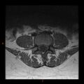 Normal spine MRI (Radiopaedia 77323-89408 Axial T1 17).jpg