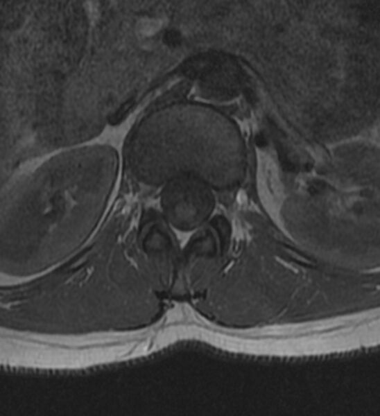 File:Normal thoracic spine MRI (Radiopaedia 41033-43781 Axial T1 33).jpg