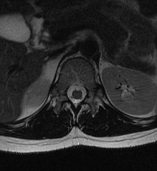 File:Normal thoracic spine MRI (Radiopaedia 41033-43781 Axial T2 28).jpg