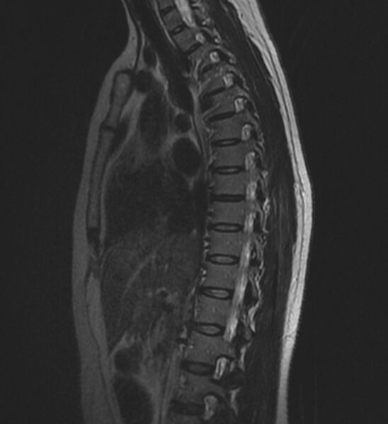 File:Normal thoracic spine MRI (Radiopaedia 41033-43781 Sagittal T2 5).jpg