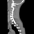 Normal trauma spine imaging (age 16) (Radiopaedia 45335-49358 C 28).jpg