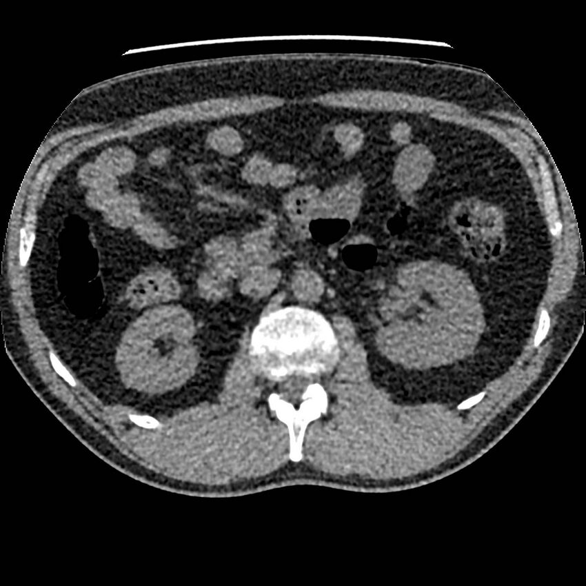 Obstructing ureteric calculus and ureteric anatomy (Radiopaedia 62730-71042 Axial non-contrast 40).jpg