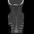 Occipital condyle fracture (Radiopaedia 31755-32691 Coronal bone window 33).jpg