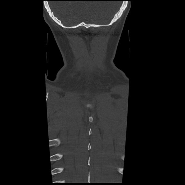 File:Occipital condyle fracture (Radiopaedia 31755-32691 Coronal bone window 39).jpg