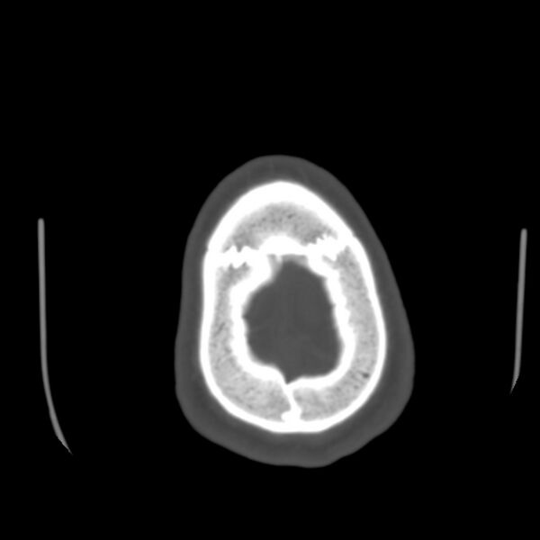 File:Occipital spur - asymptomatic (Radiopaedia 87753-104201 Axial bone window 201).jpg