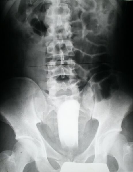File:Pear-shaped bladder (Radiopaedia 20899).jpg