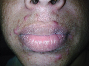 Steroid-induced peri-oral dermatitis
