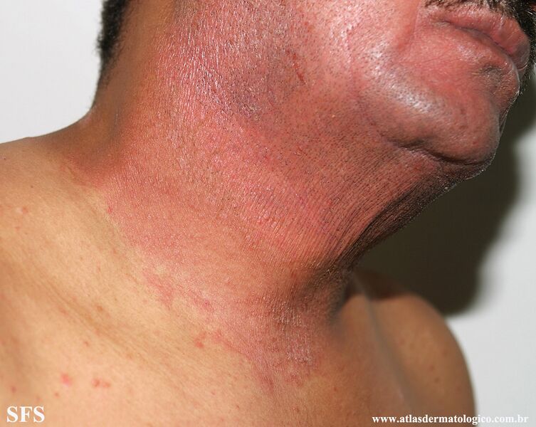 File:Psoriasis (Dermatology Atlas 116).jpg
