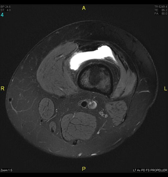 File:ACL mucoid degeration with cystic changes (Radiopaedia 48428-53341 Axial PD fat sat 1).jpg