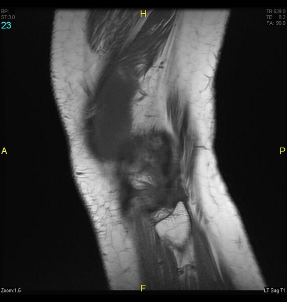File:ACL mucoid degeration with cystic changes (Radiopaedia 48428-53341 Sagittal T1 21).jpg