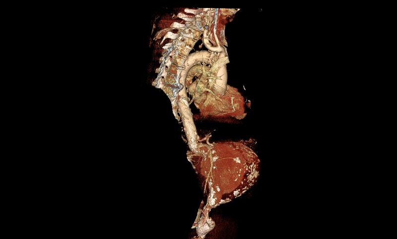 File:Abdominal aortic aneurysm- extremely large, ruptured (Radiopaedia 19882-19921 3D 20).jpg