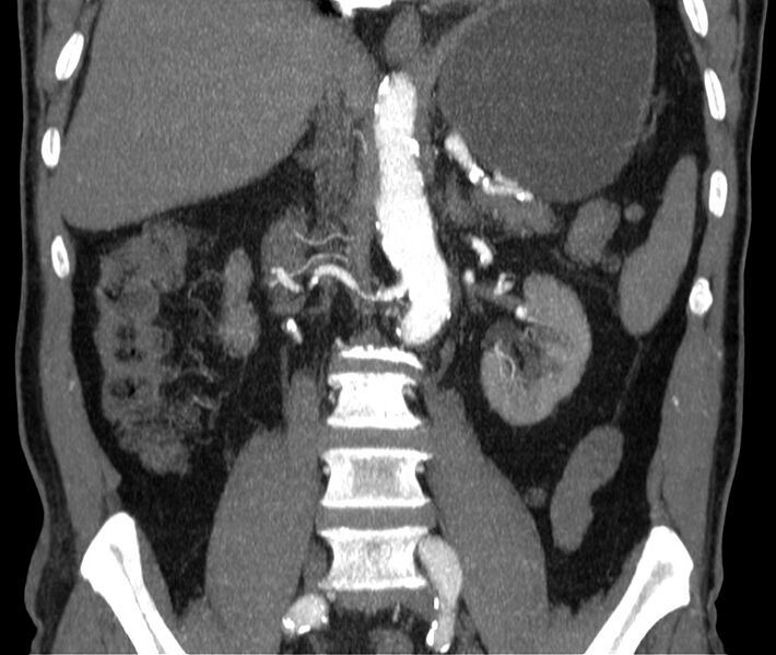 File:Abdominal aortic aneurysm (Radiopaedia 22421-22458 C 24).jpg
