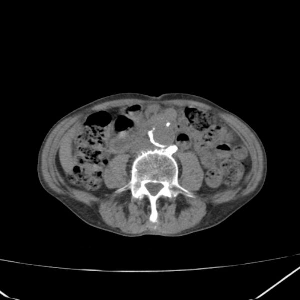 File:Abdominal aortic aneurysm (Radiopaedia 23703-23856 Axial non-contrast 30).jpg