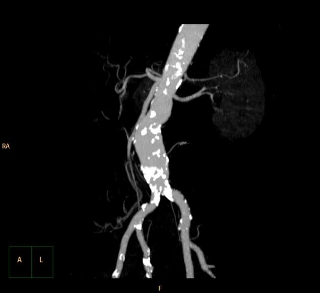 File:Abdominal aortic aneurysm (Radiopaedia 23703-23856 MIP 23).jpg