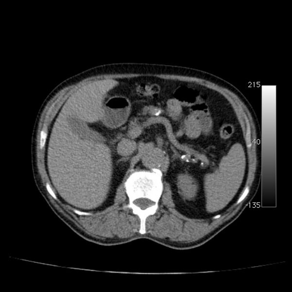 File:Abdominal aortic aneurysm (Radiopaedia 29248-29660 Axial non-contrast 19).jpg