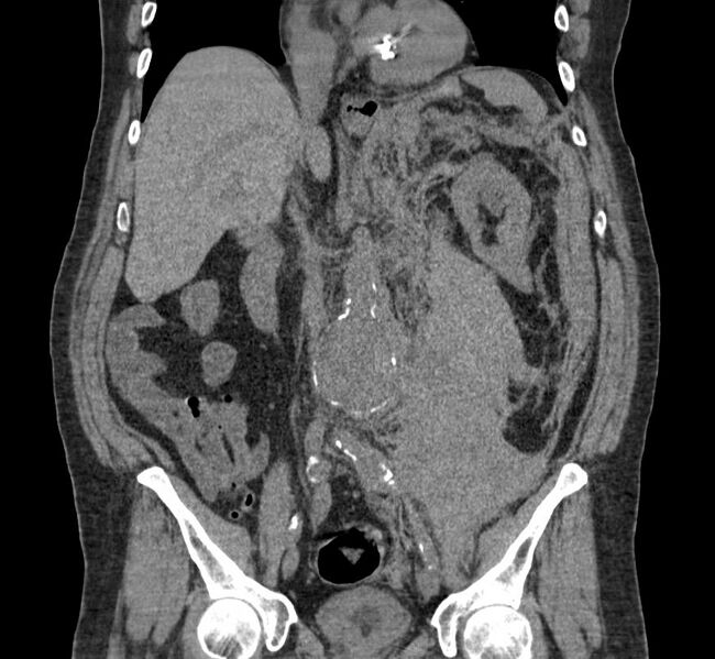 File:Abdominal aortic aneurysm rupture (Radiopaedia 11149-11514 Coronal non-contrast 1).jpg