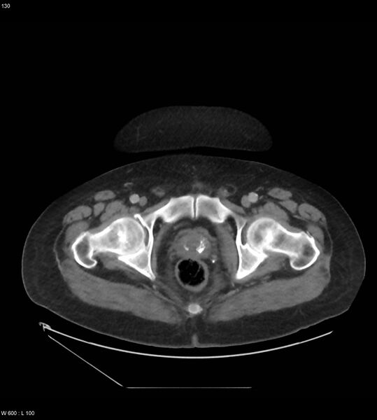 File:Abdominal aortic aneurysm with intramural hematoma then rupture (Radiopaedia 50278-55631 Axial C+ arterial phase 121).jpg