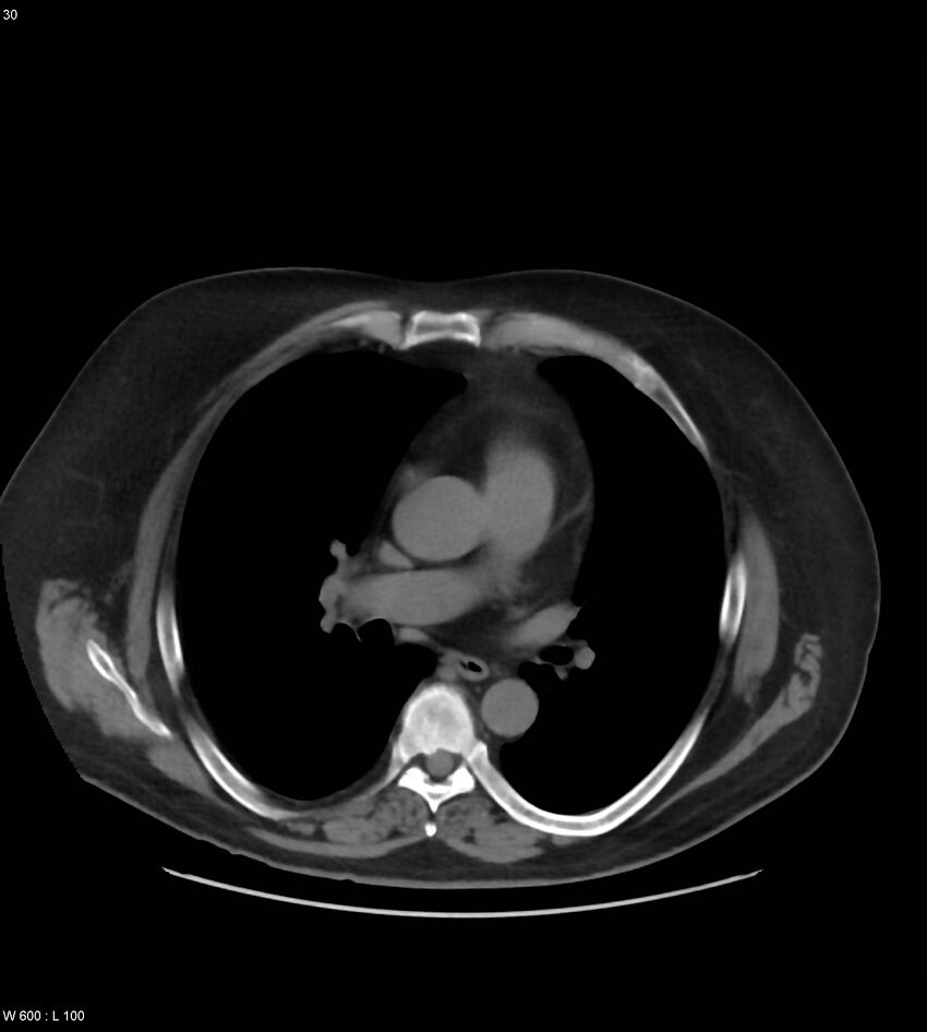 Abdominal aortic aneurysm with intramural hematoma then rupture (Radiopaedia 50278-55631 Axial non-contrast 26).jpg